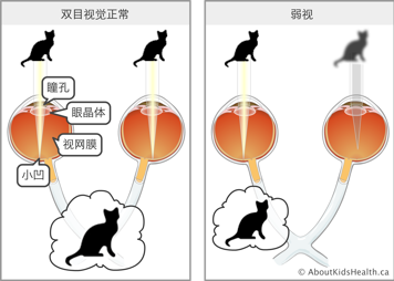 弱视示意图:从右眼看到的猫非常清晰,而左眼看到的猫是模糊的